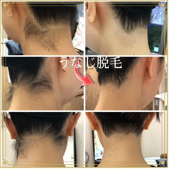 ♡レディースフェイシャル脱毛・美肌パーフェクトコース