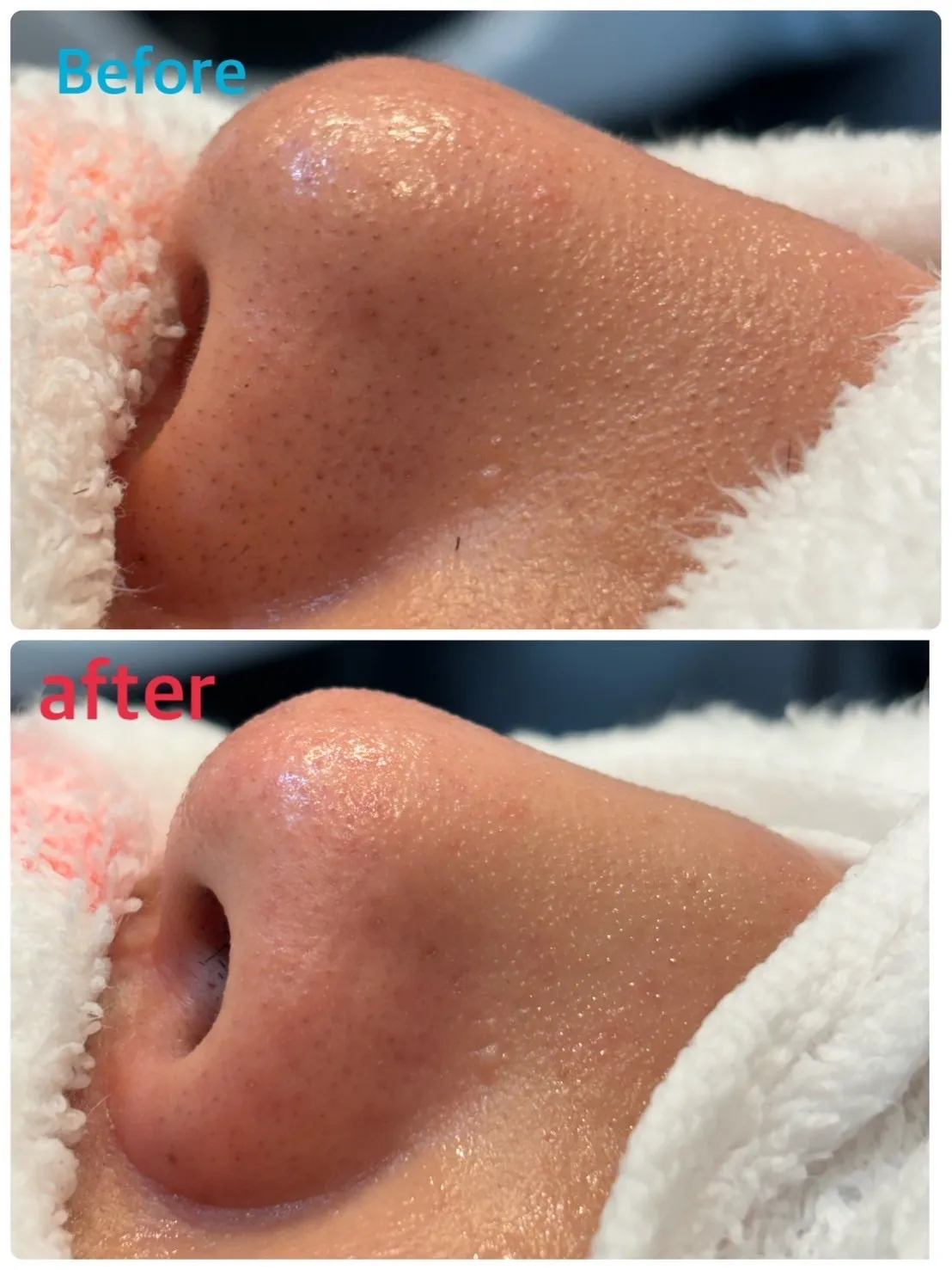 メンズシェービング鼻そりエステSSコース　