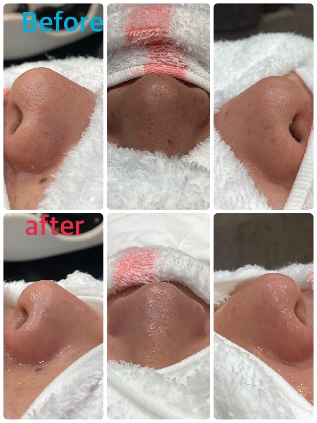 メンズシェービング鼻そりプレミアコース　