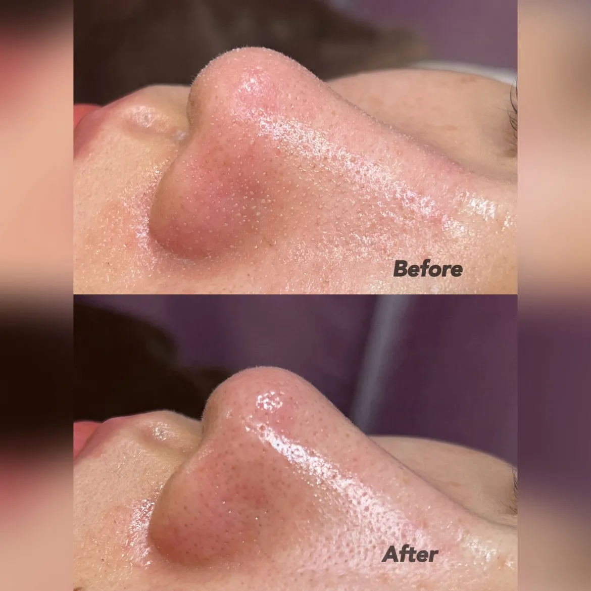 顔+小鼻洗浄+拭き取りパック