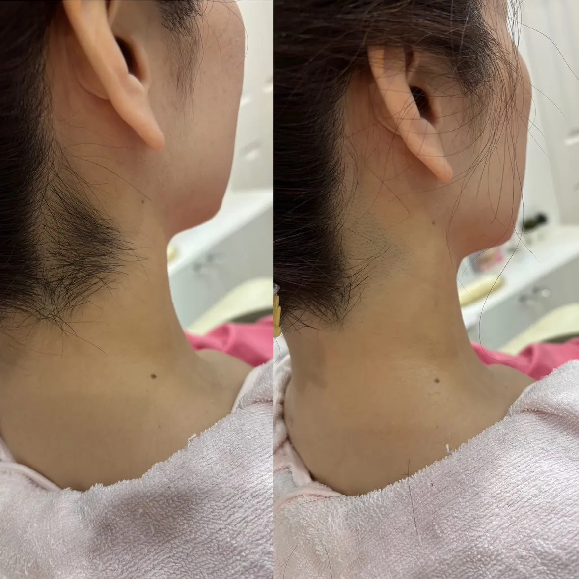うなじ剃り+うなじ脱毛　