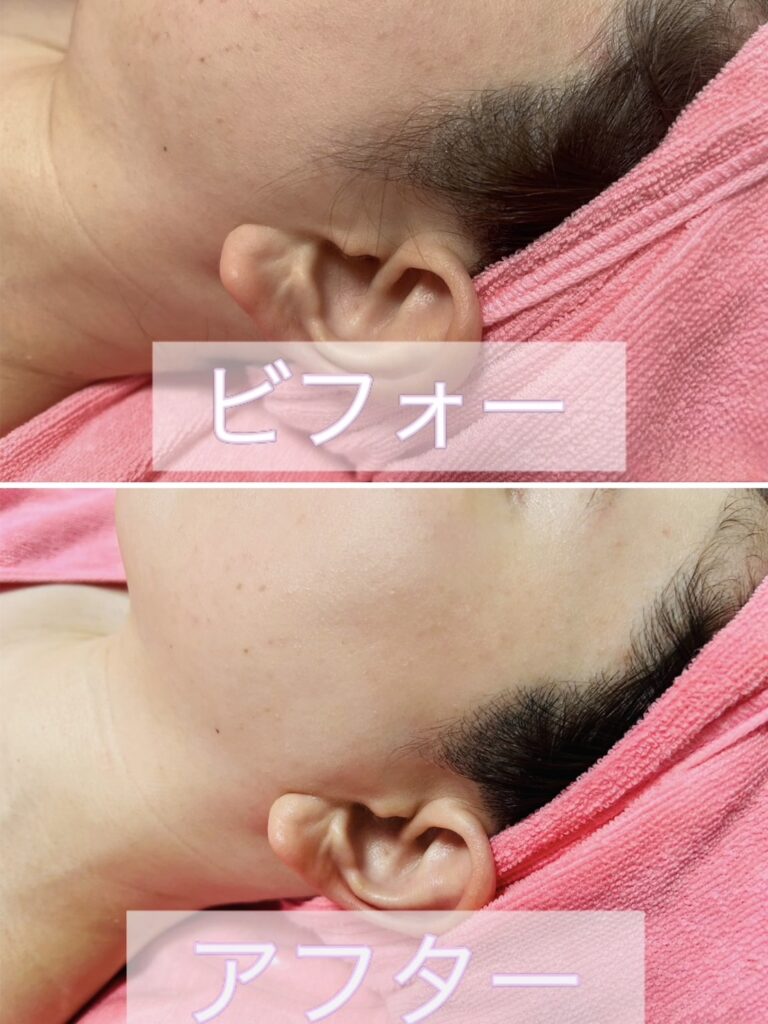 小顔シェービング